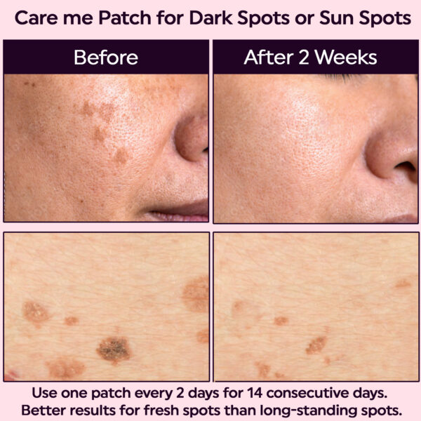 microneedle patches for dark spots