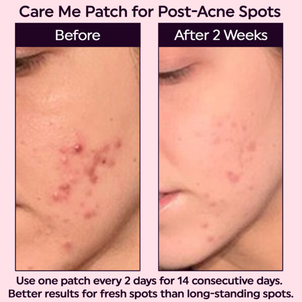 micropoint patch for acne pimple blemish spots