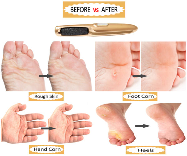 foot care callus remover